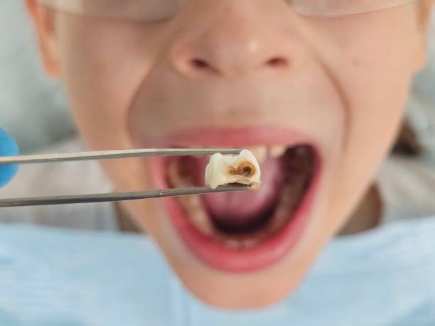 Best Emergency Tooth Extraction  in Mequon, WI